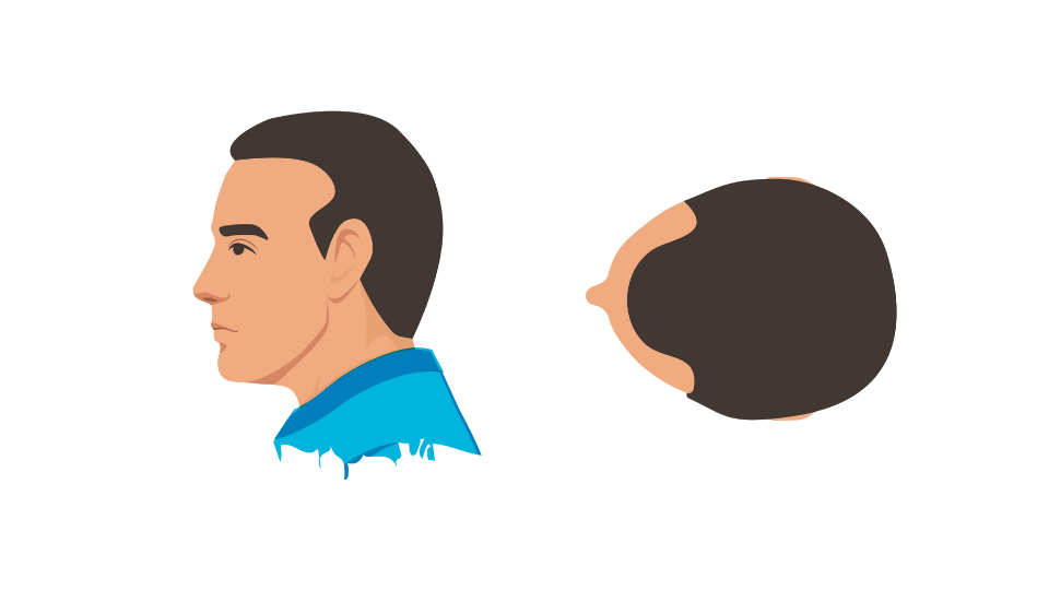 Haartransplantatie mannen 2