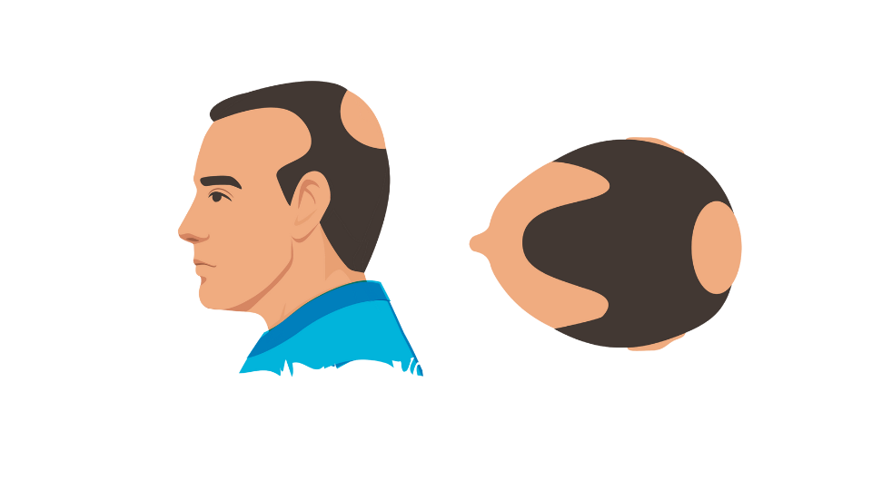 Haartransplantatie mannen 4