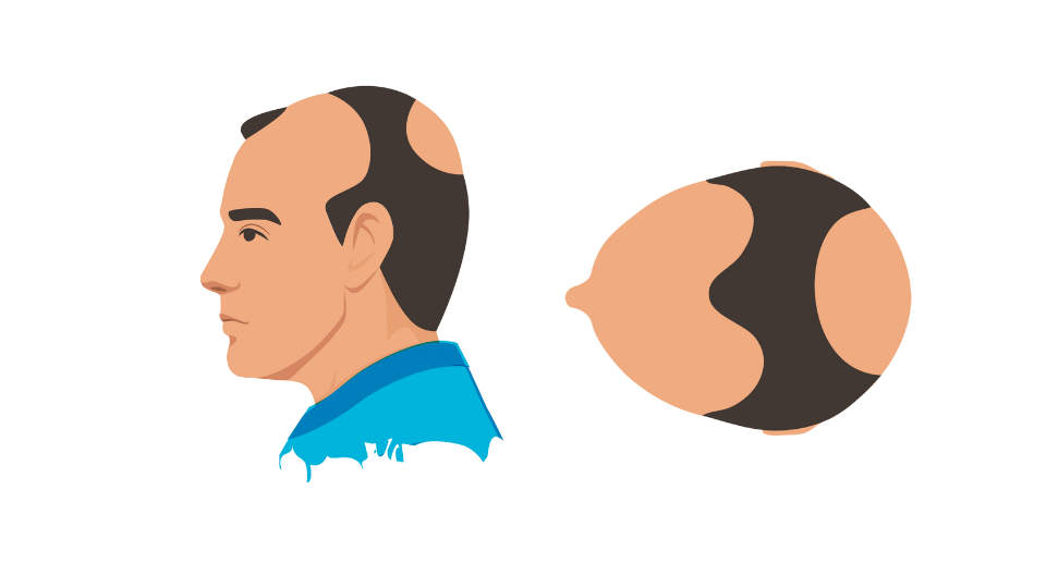 Haartransplantatie mannen 5