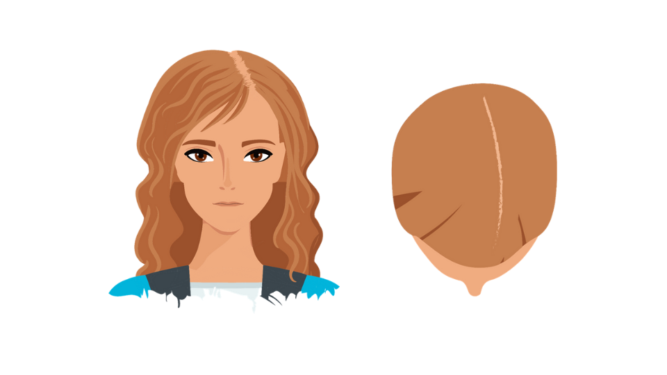 Haartransplantatie vrouwen indicatie 1