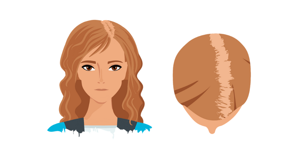 Haartransplantatie vrouwen indicatie 2