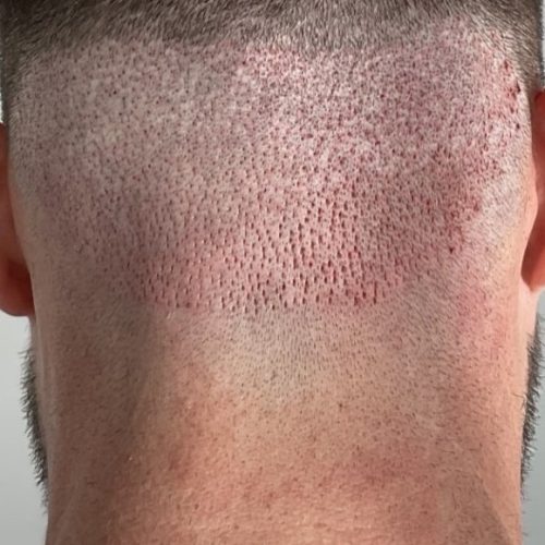 haartransplantatie resultaat