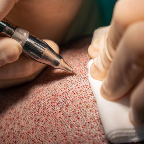 Close up of a hair surgeon hands extracting follicles from the head of a patient with a circular scalpel called a punch.